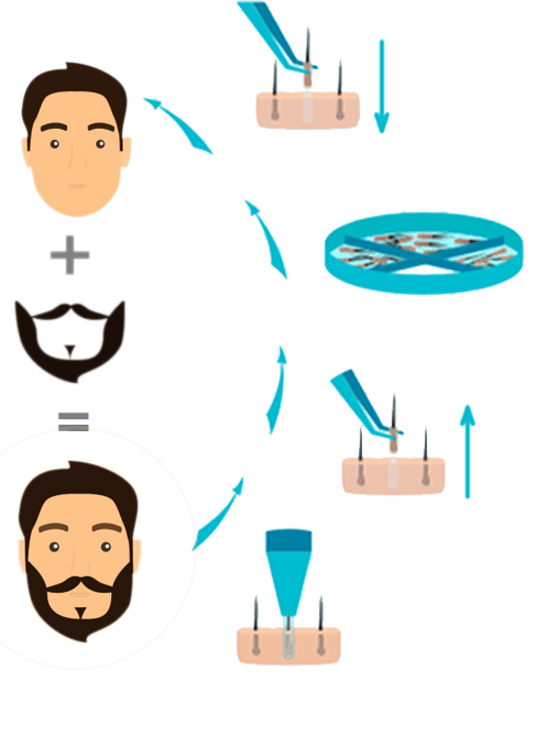  Beard transplant make you a complete man