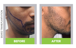 fue hair transplant before and after pictures