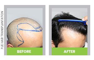 fue hair transplant before and after pictures