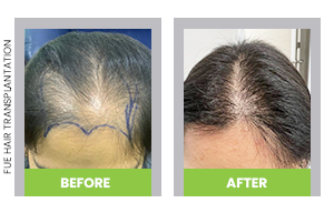 fue hair transplant before and after pictures