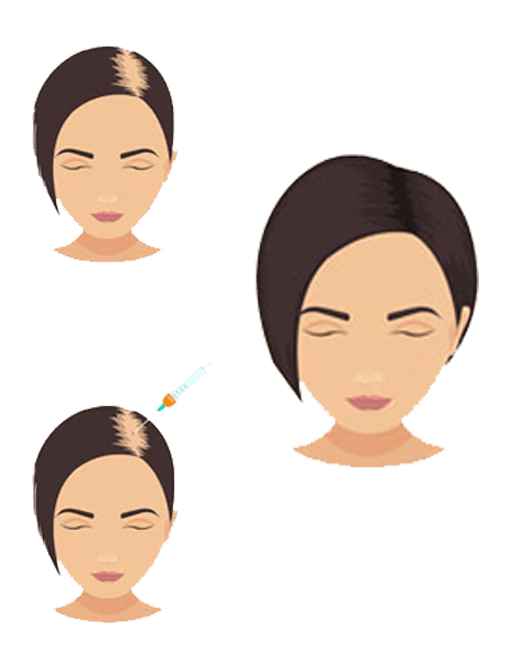 Platelet rich plasma