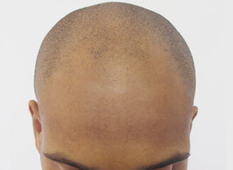 scalp micropigmentaion give you 100% natural results