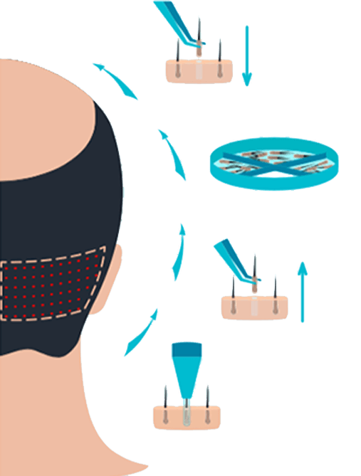 Fue hair transplant4 before and after