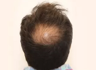 Beard Hair Transplant Surgery
