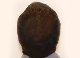 Beard Hair Transplant Surgery